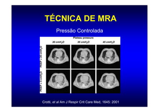 TÉCNICA DE MRA
         Pressão Controlada




Crotti, et al Am J Respir Crit Care Med, 1645: 2001
 