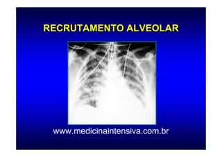 RECRUTAMENTO ALVEOLAR




 www.medicinaintensiva.com.br
 
