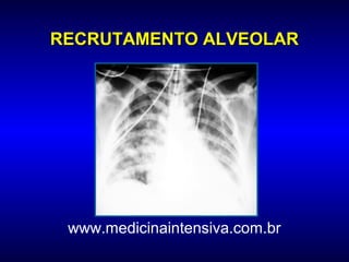 RECRUTAMENTO ALVEOLAR




 www.medicinaintensiva.com.br
 