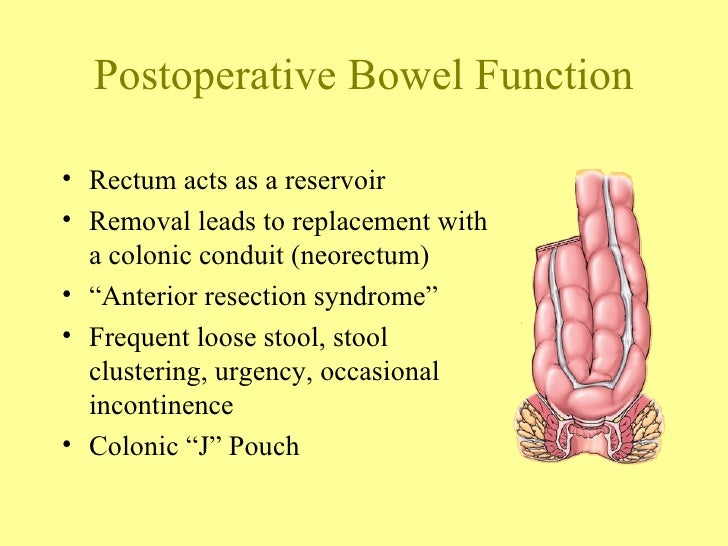 The Surgery for Rectal Cancer