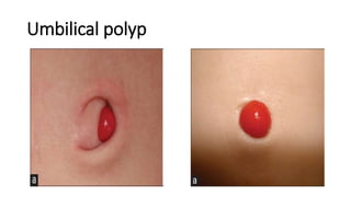 Umbilical polyp
 
