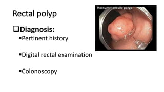 Rectal polyp
Diagnosis:
Pertinent history
Digital rectal examination
Colonoscopy
 