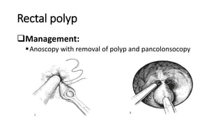Rectal polyp
Management:
Anoscopy with removal of polyp and pancolonsocopy
 