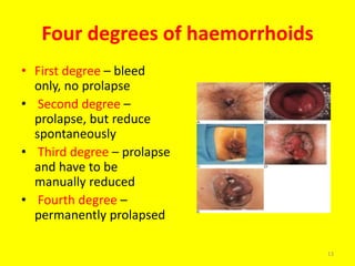 Four degrees of haemorrhoids
• First degree – bleed
only, no prolapse
• Second degree –
prolapse, but reduce
spontaneously
• Third degree – prolapse
and have to be
manually reduced
• Fourth degree –
permanently prolapsed
13
 
