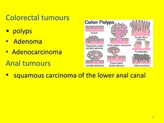 Colorectal tumours
• polyps
• Adenoma
• Adenocarcinoma
Anal tumours
• squamous carcinoma of the lower anal canal
18
 
