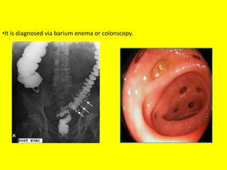 •It is diagnosed via barium enema or colonscopy.
 
