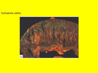 •Ischaemic colitis
 