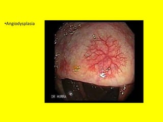 •Angiodysplasia
 