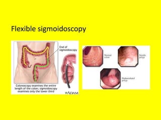 Flexible sigmoidoscopy
 