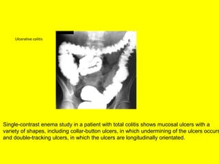 Single-contrast enema study in a patient with total colitis shows mucosal ulcers with a
variety of shapes, including collar-button ulcers, in which undermining of the ulcers occurs
and double-tracking ulcers, in which the ulcers are longitudinally orientated.
Ulcerative colitis
 