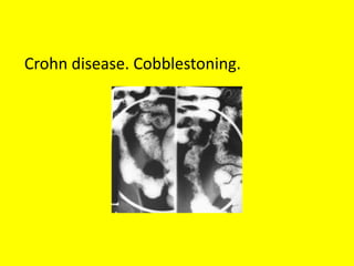 Crohn disease. Cobblestoning.
 