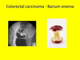 Colorectal carcinoma - Barium enema
 