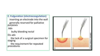 Fulgurated Rectal cancer By Dr Efrem Ayalew Wossen | PPTX