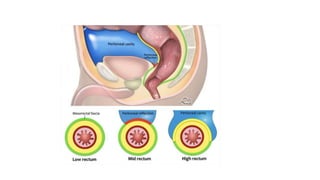 rectal cancer 2024 management guidelines