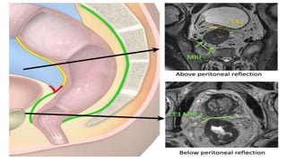 rectal cancer 2024 management guidelines