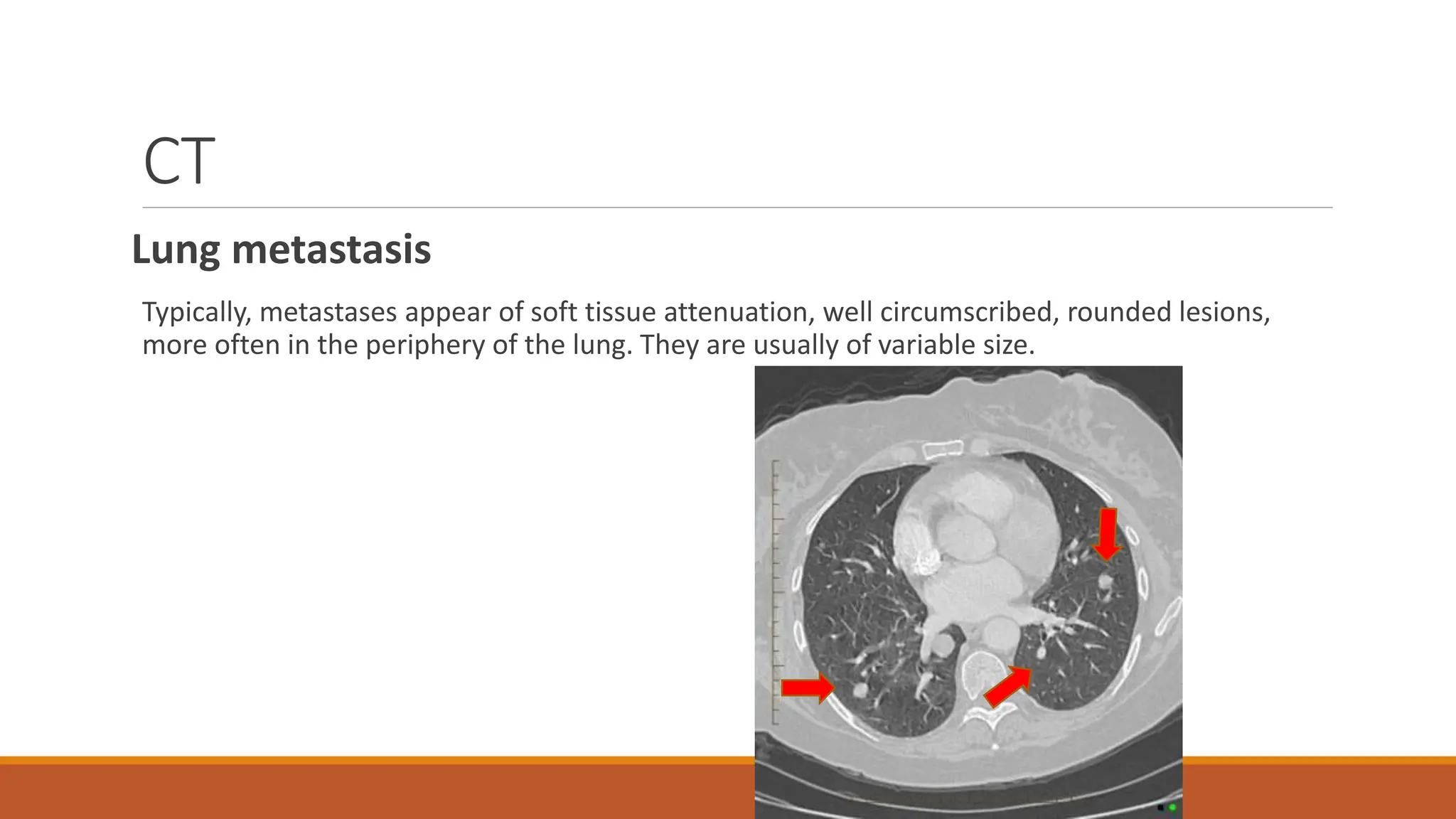 rectal cancer staging;Imaging for rectal cancer staging -Endoscopic