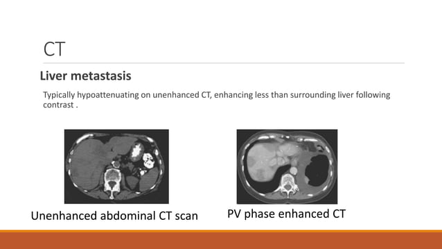 rectal cancer staging;Imaging for rectal cancer staging -Endoscopic