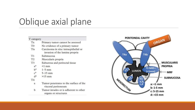 rectal cancer staging;Imaging for rectal cancer staging -Endoscopic ...