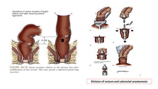 Proctotomy Rectal Carcinoma | PPTX