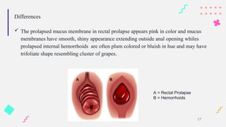 Differences
 The prolapsed mucus membrane in rectal prolapse appears pink in color and mucus
membranes have smooth, shiny appearance extending outside anal opening whiles
prolapsed internal hemorrhoids are often plum colored or bluish in hue and may have
trifoliate shape resembling cluster of grapes.
17
A = Rectal Prolapse
B = Hemorrhoids
 