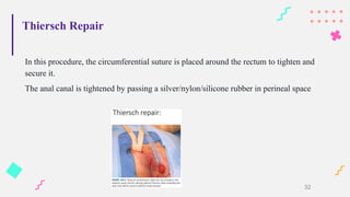 Thiersch Repair
In this procedure, the circumferential suture is placed around the rectum to tighten and
secure it.
The anal canal is tightened by passing a silver/nylon/silicone rubber in perineal space
32
 