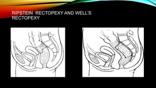 Rectal Prolapse-1 (2).pptx