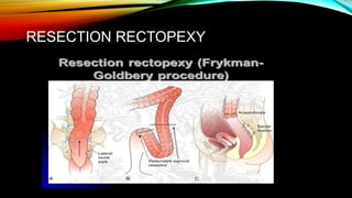 Rectal Prolapse-1 (2).pptx