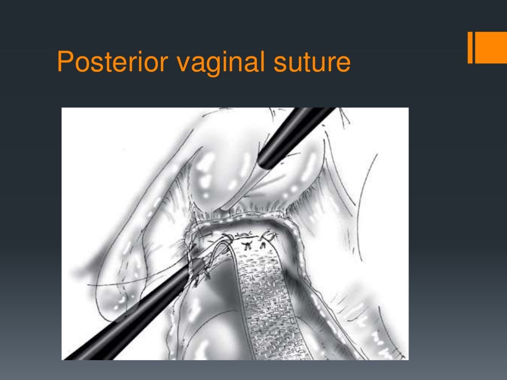 Rectal prolapse