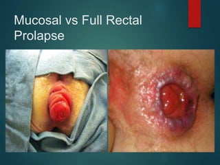 Mucosal vs Full Rectal
Prolapse
 