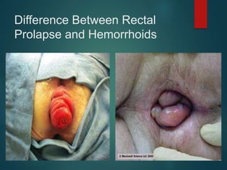 Difference Between Rectal
Prolapse and Hemorrhoids
 