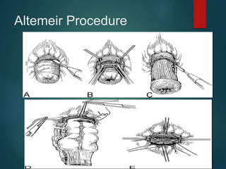 Altemeir Procedure
 