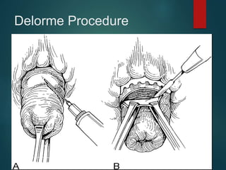 Delorme Procedure
 