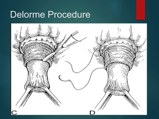 Delorme Procedure
 