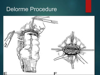 Delorme Procedure
 
