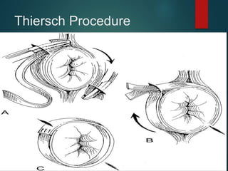 Thiersch Procedure
 