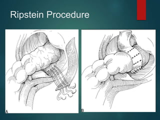 Ripstein Procedure
 