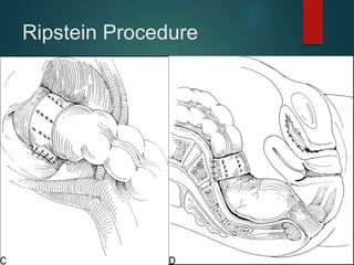 Ripstein Procedure
 