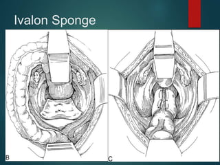 Ivalon Sponge
 