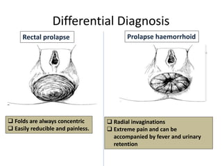 Rectal prolapse | PPTX