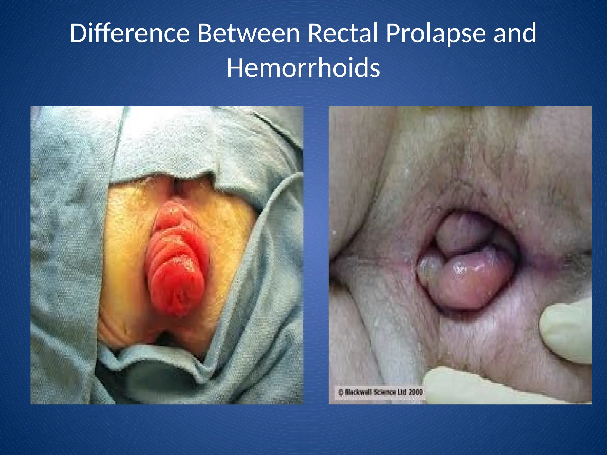 Difference Between Rectal Prolapse and
Hemorrhoids
 