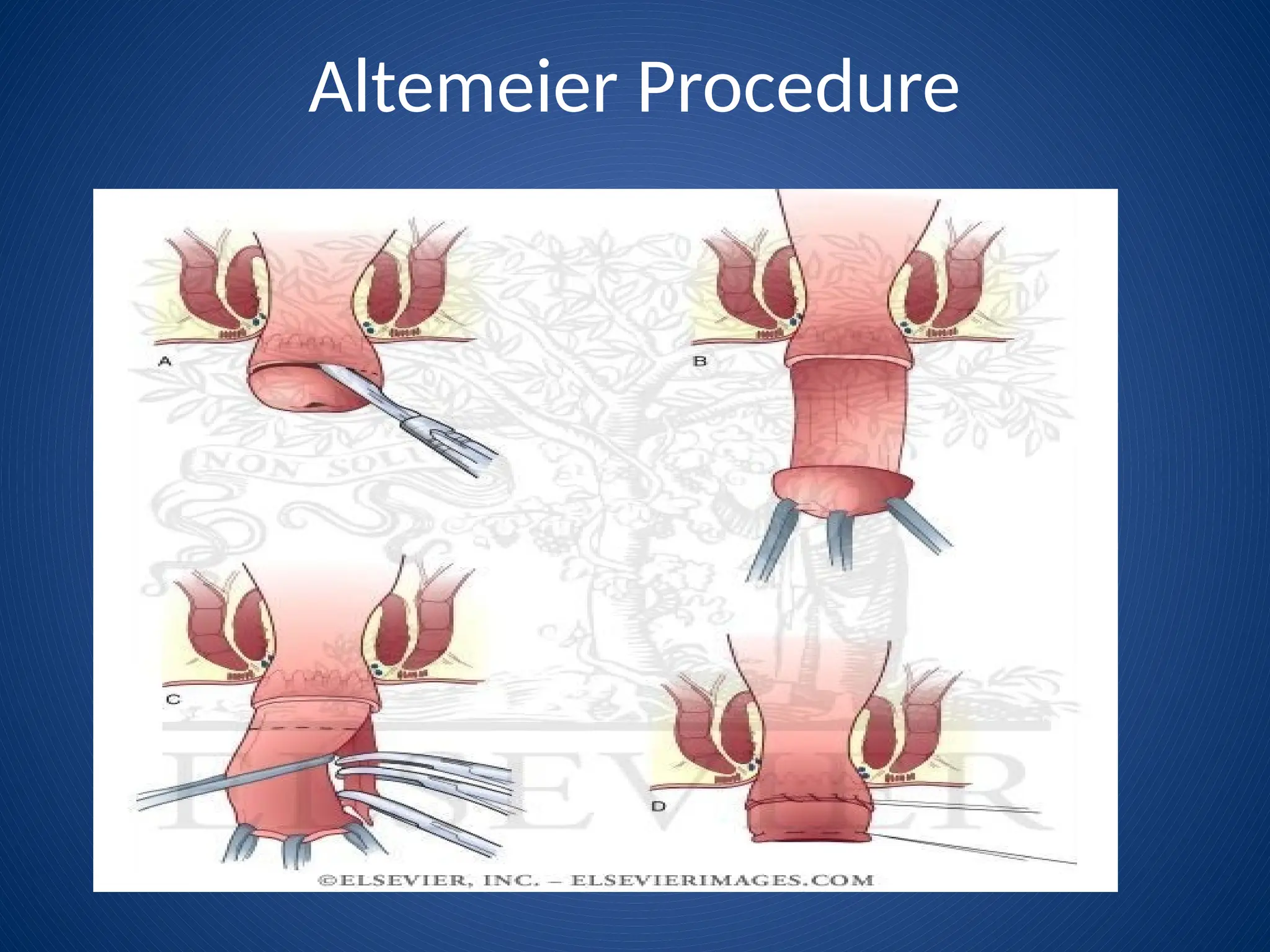 Altemeier Procedure
 
