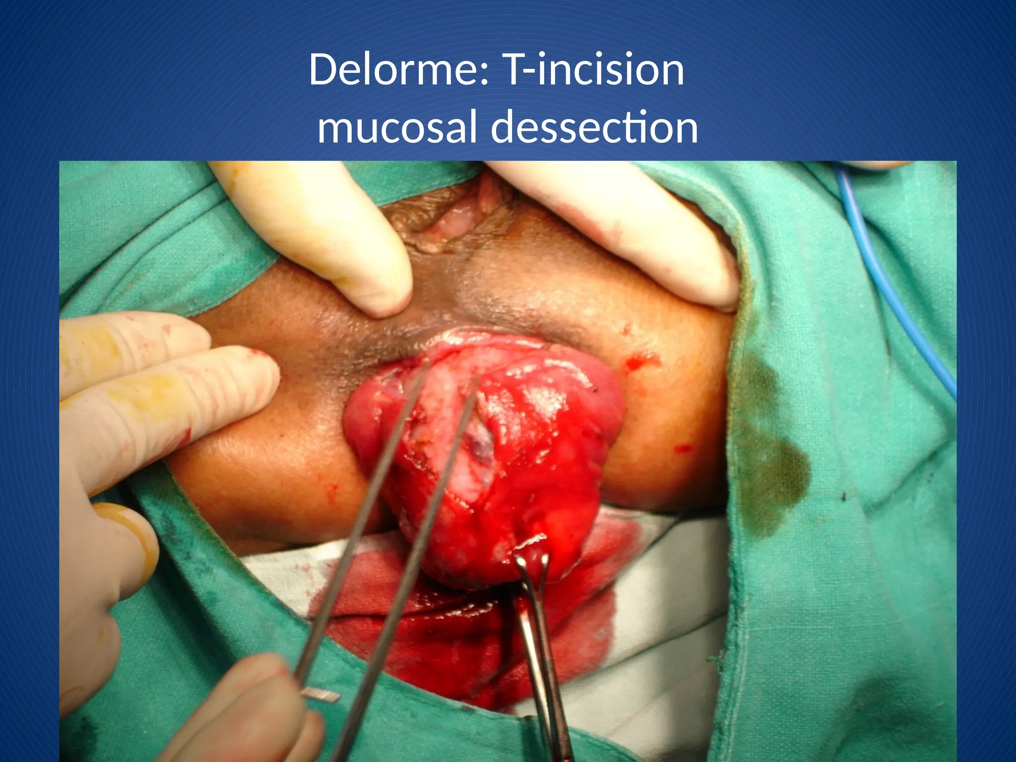 Delorme: T-incision
mucosal dessection
 