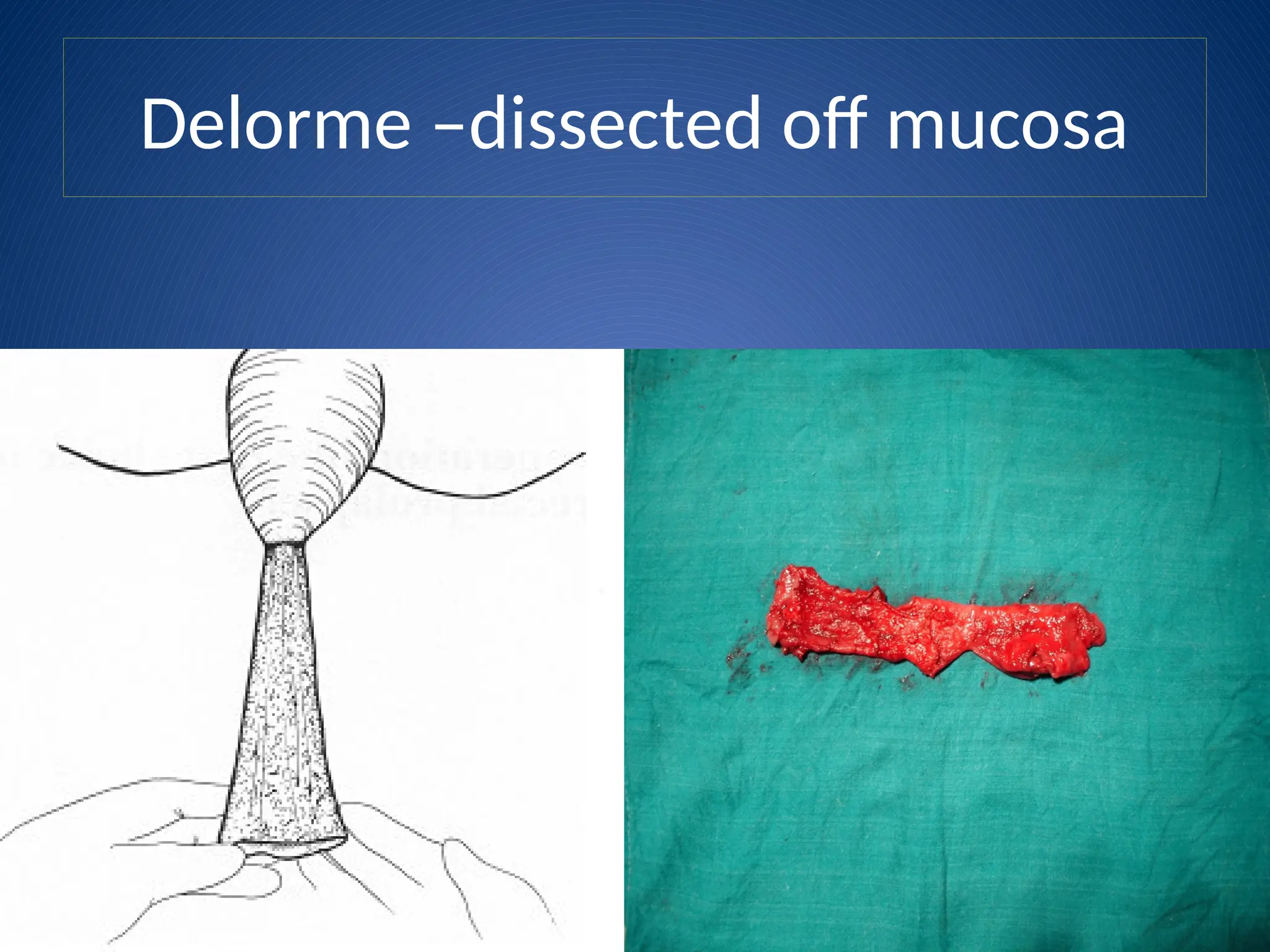 Delorme –dissected off mucosa
 