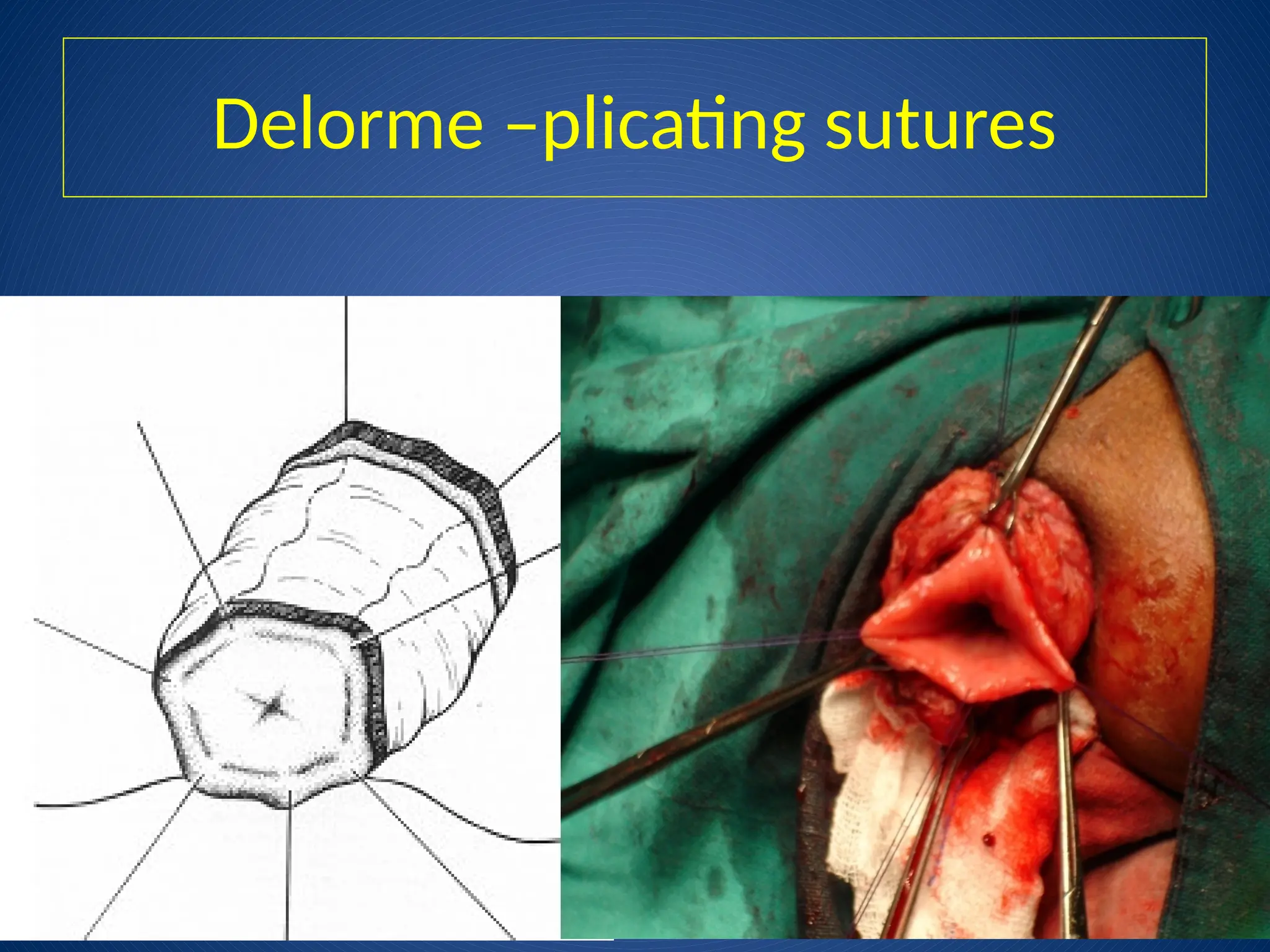 Delorme –plicating sutures
 