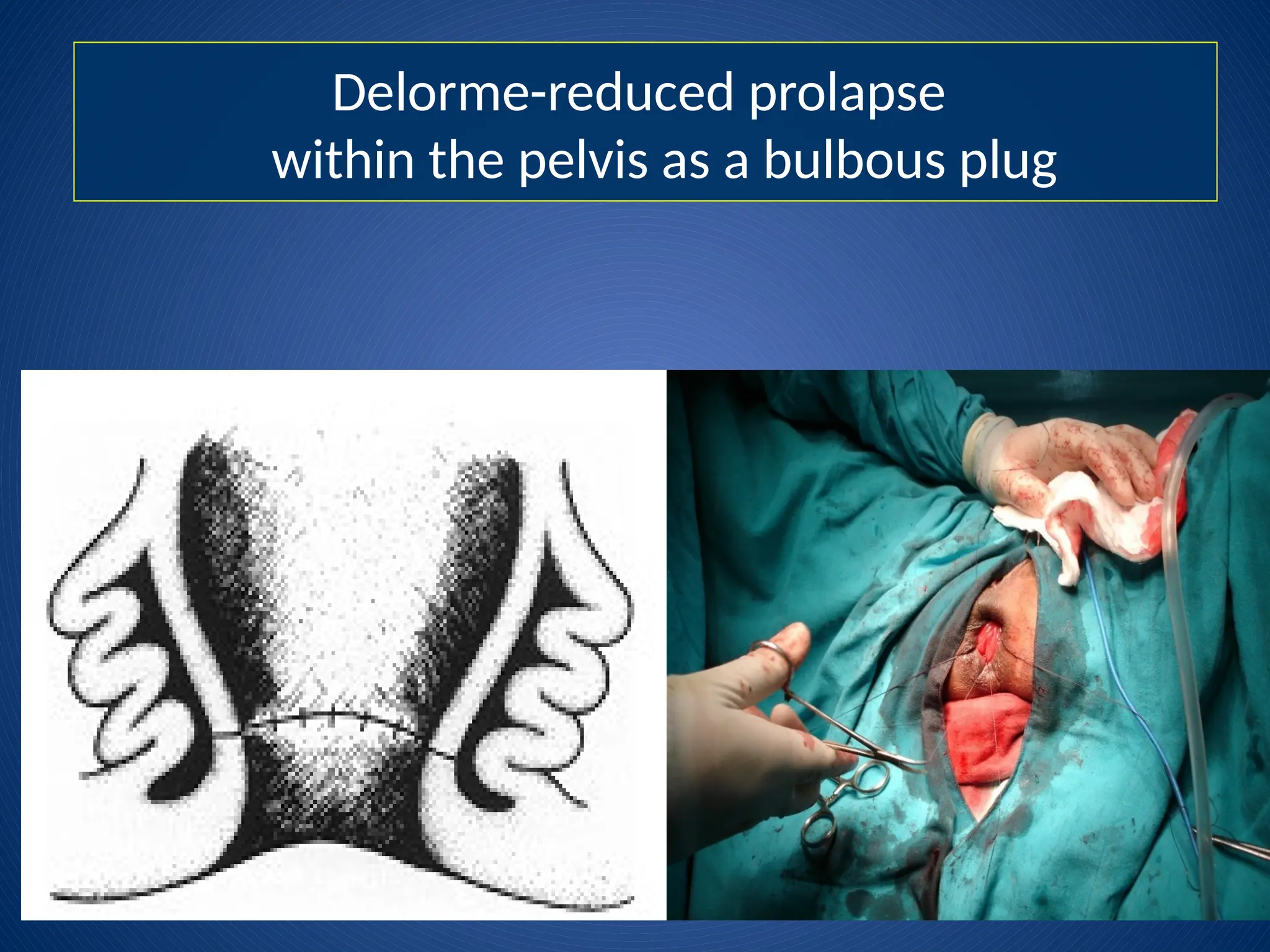 Delorme-reduced prolapse
within the pelvis as a bulbous plug
 
