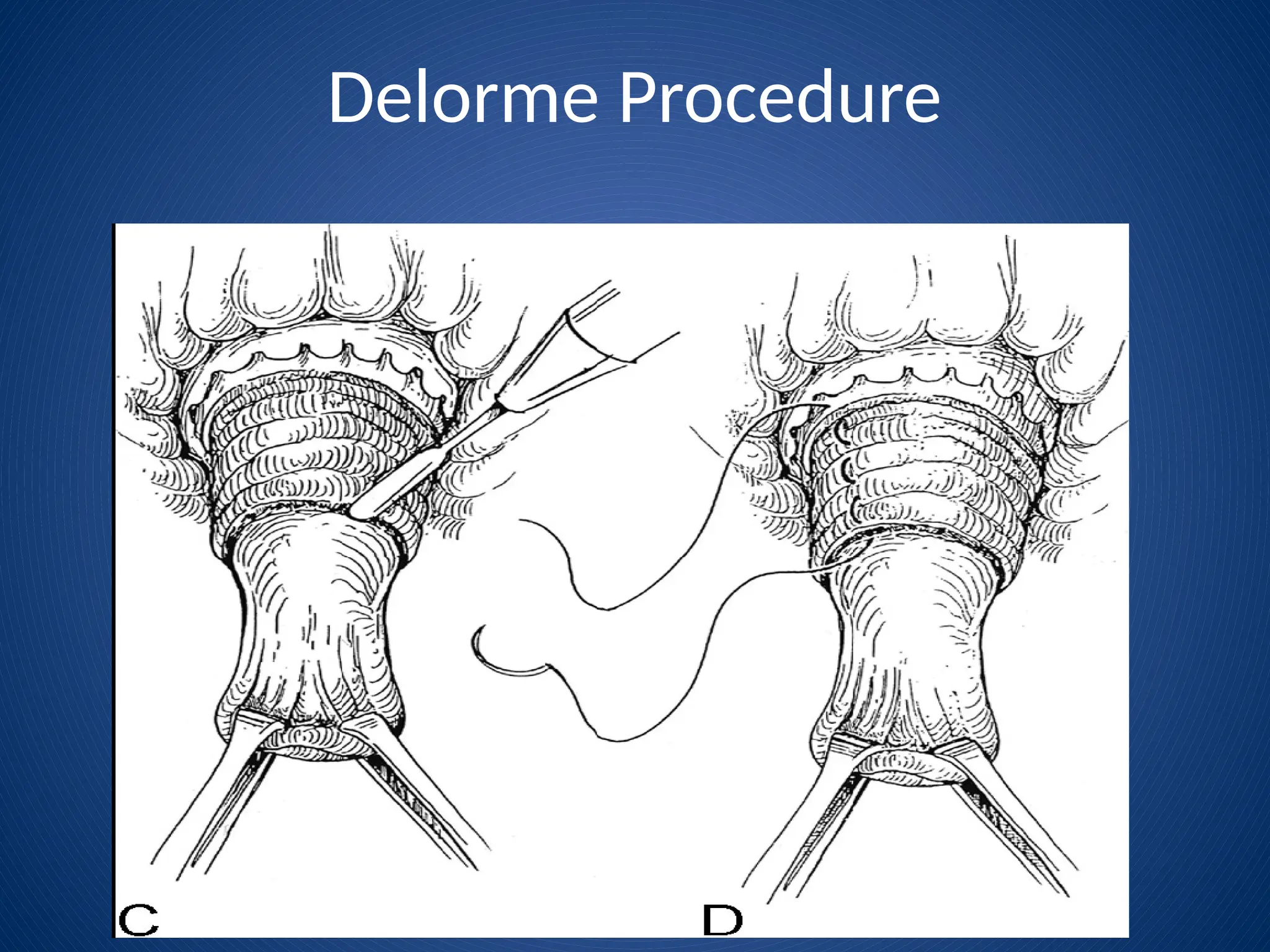 Delorme Procedure
 