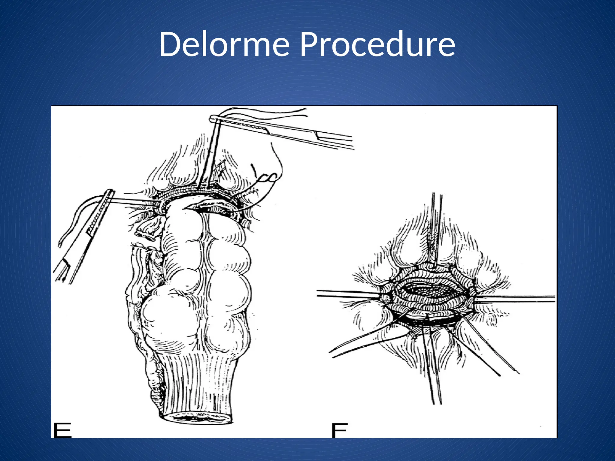 Delorme Procedure
 