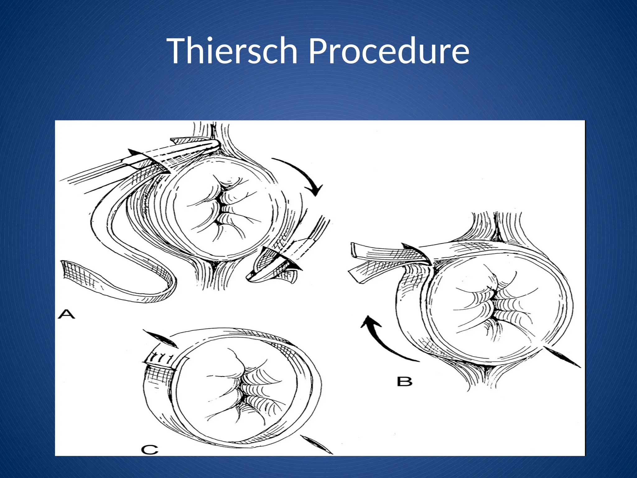 Thiersch Procedure
 