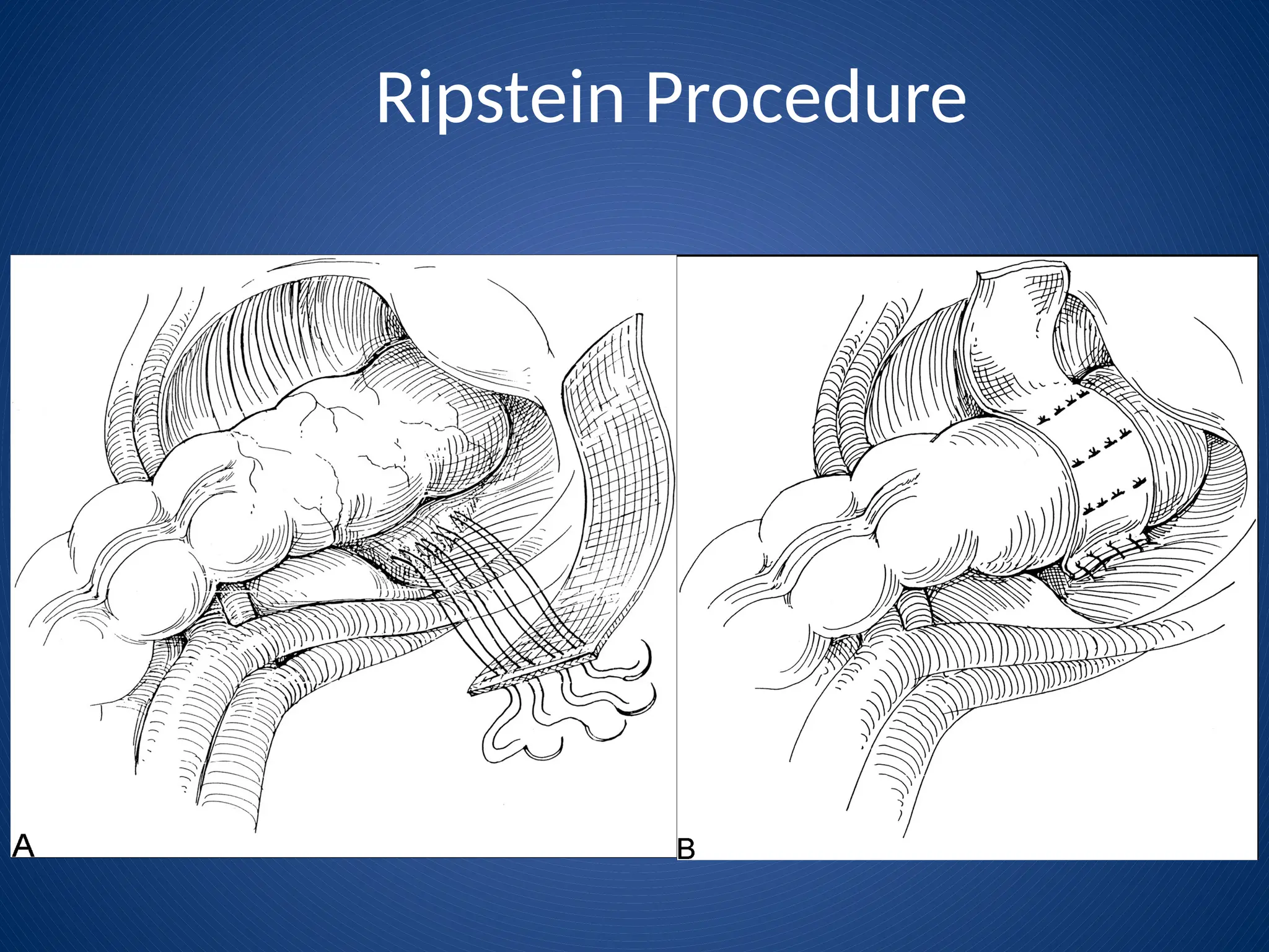 Ripstein Procedure
 