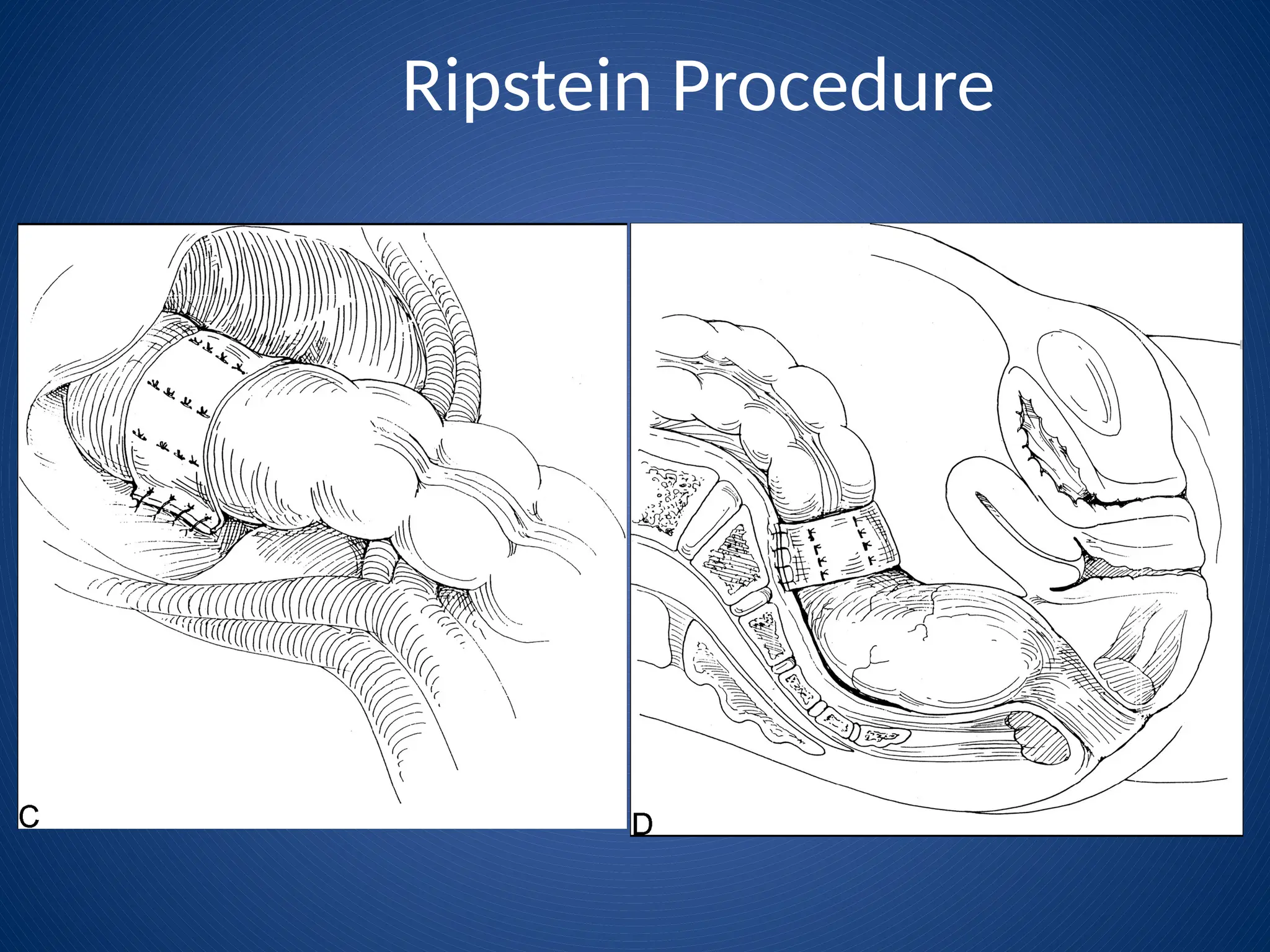 Ripstein Procedure
 